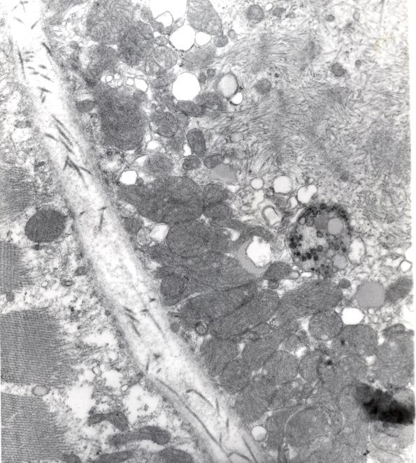 11A1 Mitochondrial myopathy (Case 11) EM - Copy