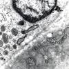 12A1 Mitochondrial Myopathy (Case 12) EM 2 - Copy