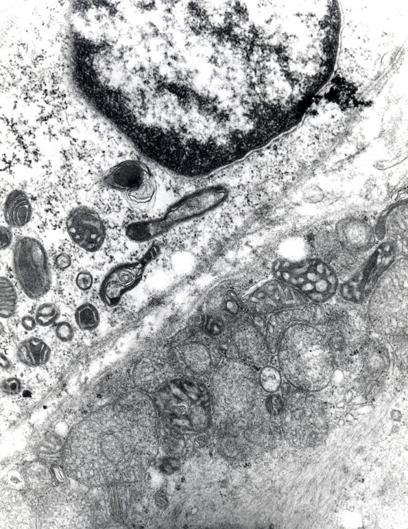 12A1 Mitochondrial Myopathy (Case 12) EM 2 - Copy
