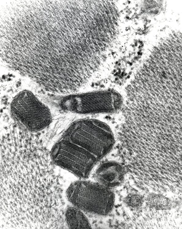 12A2 Mitochondrial Myopathy (Case 12) EM 1 - Copy