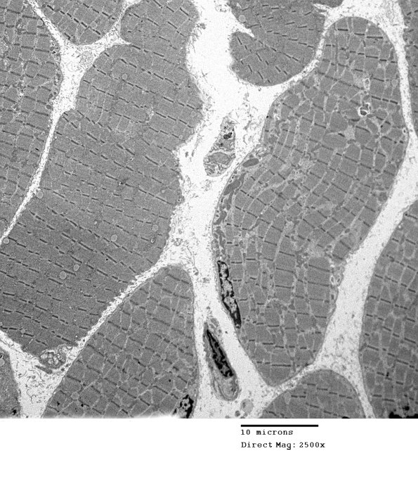 13A1A Mitochondriopathy (Case 13) EM 038 - Copy