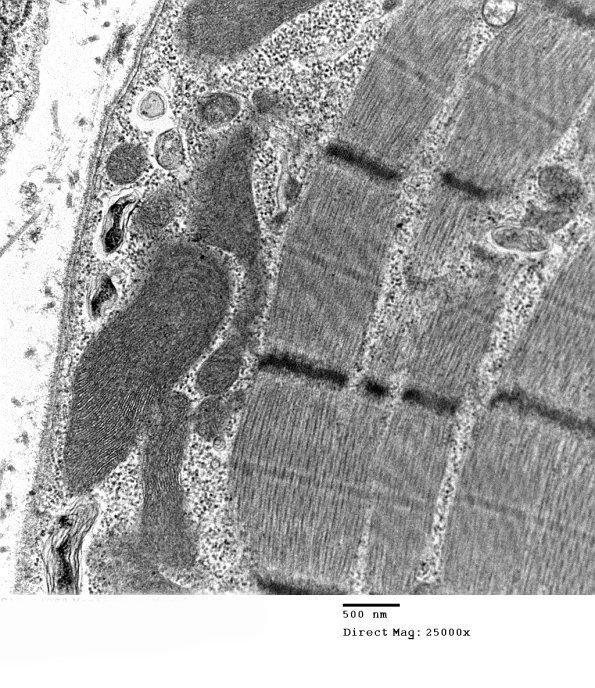 13A1C Mitochondriopathy (Case 13) EM 040 - Copy