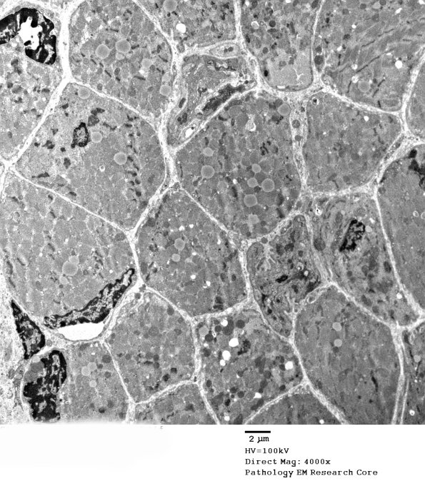 14A1A Mitochondriopathy (Case 14) EM 038 - Copy