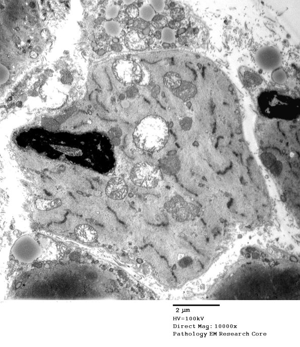 14A1B Mitochondriopathy (Case 14) EM 001 - Copy