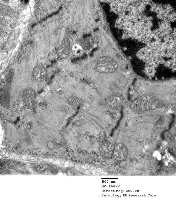 14A1C Mitochondriopathy (Case 14) EM 005 - Copy