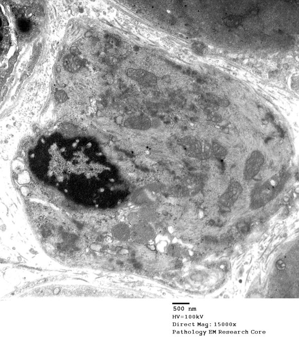 14A1D Mitochondriopathy (Case 14) EM 014 - Copy