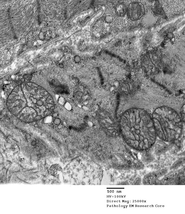 14A2B Mitochondriopathy (Case 14) EM 021 - Copy