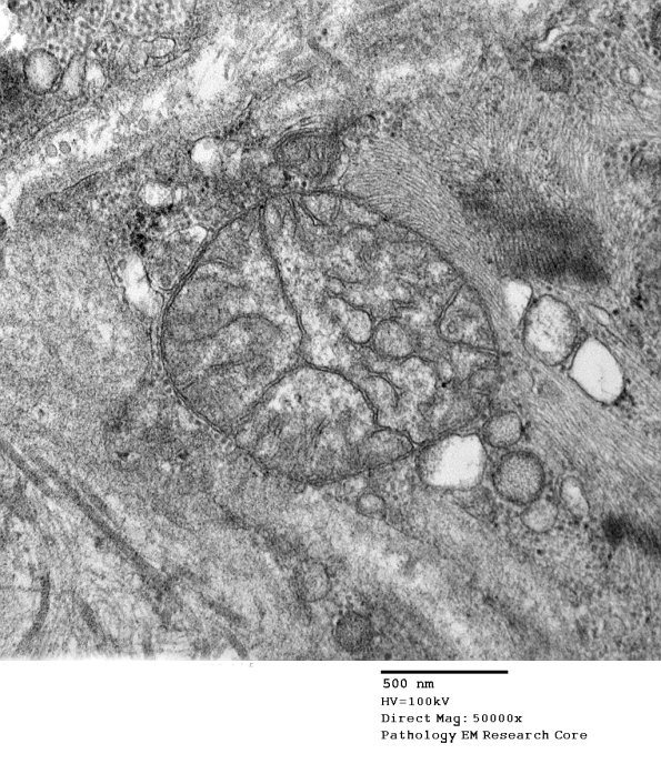 14A2C Mitochondriopathy (Case 14) EM 022 - Copy