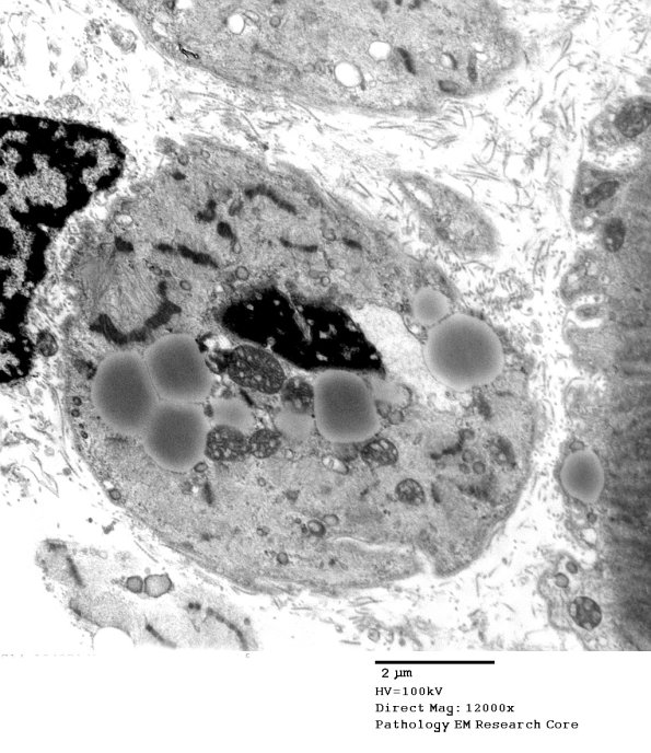 14A3A Mitochondriopathy (Case 14) EM 028 - Copy