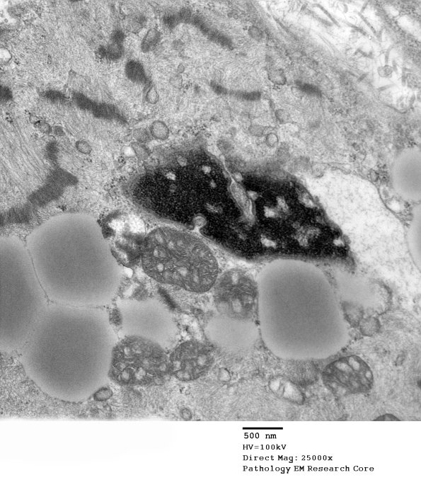 14A3B Mitochondriopathy (Case 14) EM 029 - Copy