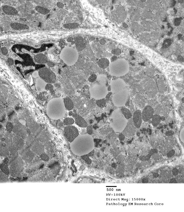 14A4 Mitochondriopathy (Case 14) EM 030 - Copy