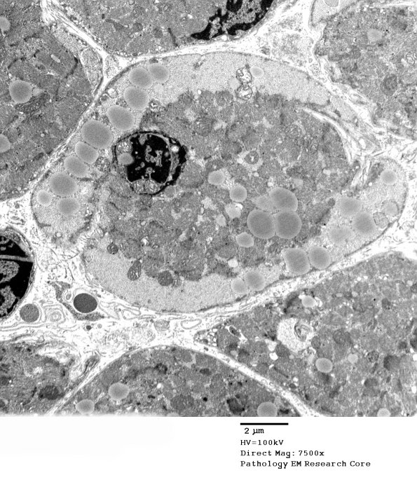 14A5A Mitochondriopathy (Case 14) EM 034 - Copy