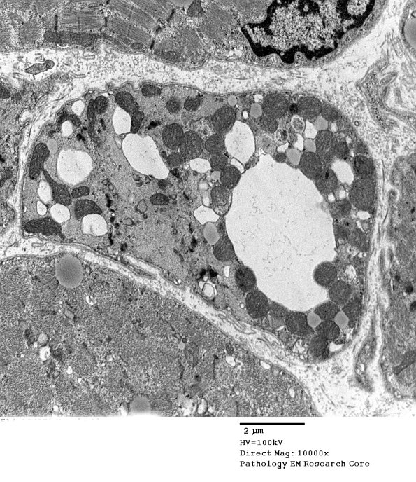14A6 Mitochondriopathy (Case 14) EM 033 - Copy