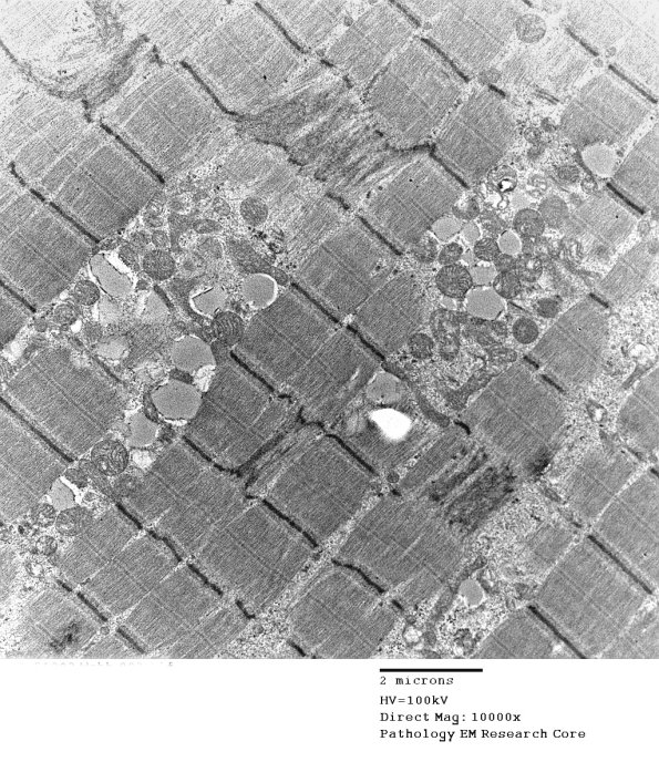 15A1 Mitochondriopathy (Case 15) 7 - Copy