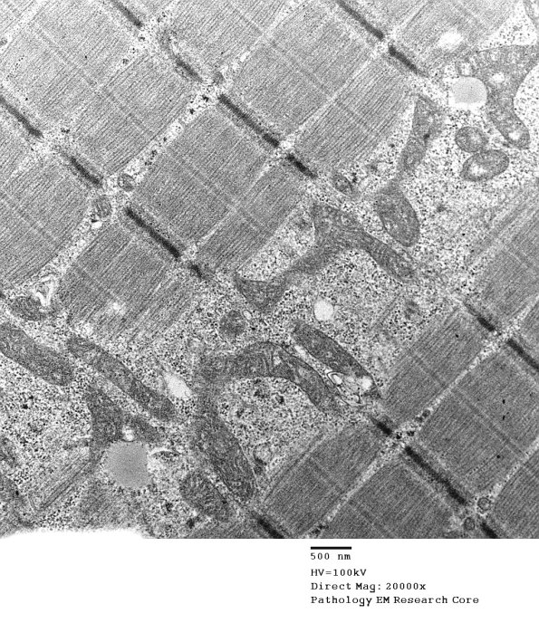 15A2 Mitochondriopathy (Case 15) EM 004 - Copy