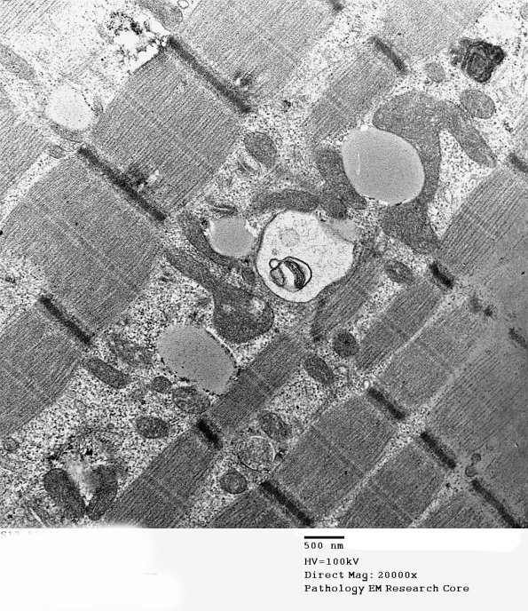 15A3 Mitochondriopathy (Case 15) EM 006 - Copy