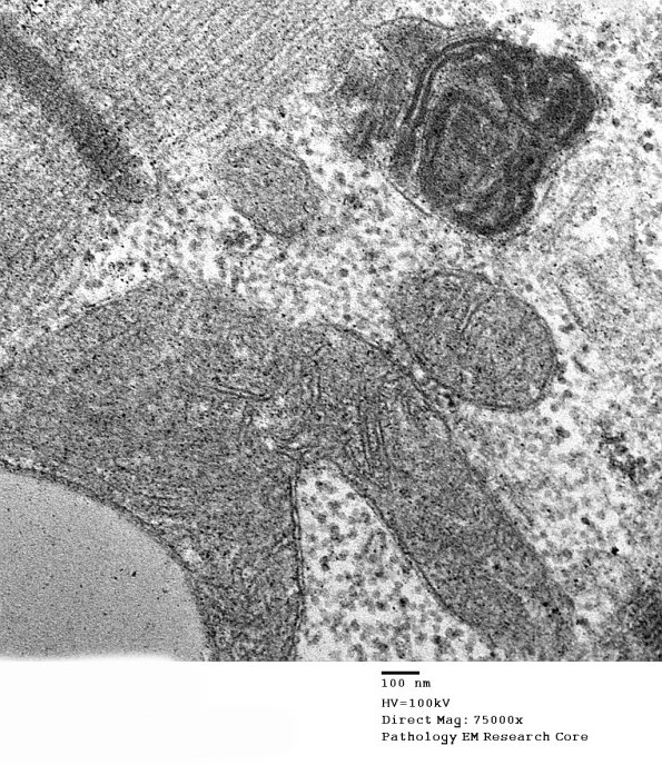 15A4 Mitochondriopathy (Case 15) EM 007 - Copy
