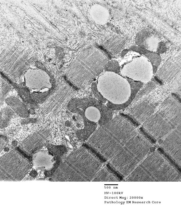 15A5A Mitochondriopathy (Case 15) EM 008 - CopyA