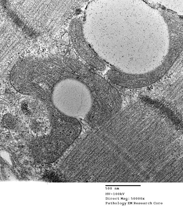 15A5B Mitochondriopathy (Case 15) EM 009 - Copy