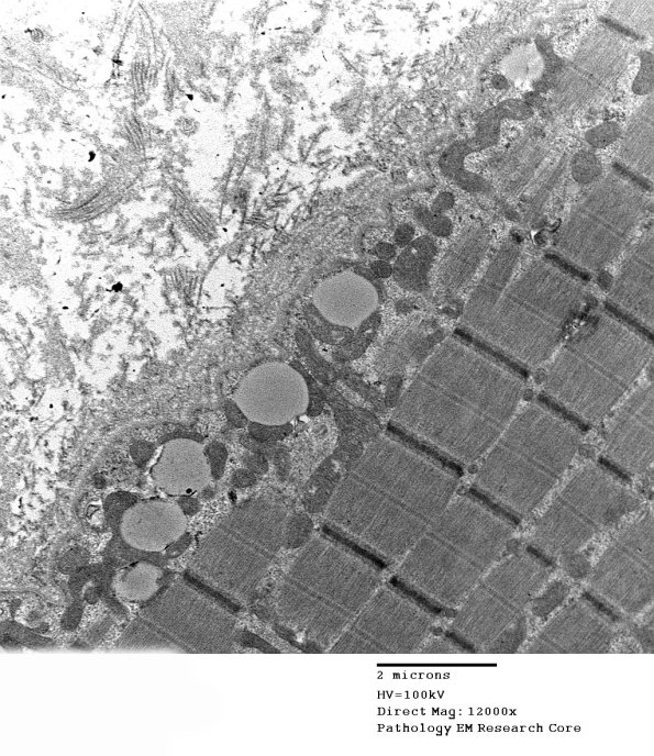 15A5C Mitochondriopathy (Case 15) EM 010 - Copy