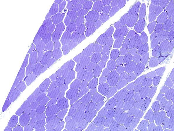 16A1-Mitochondriopathy-mild-Case-16-Plastic-2.jpg