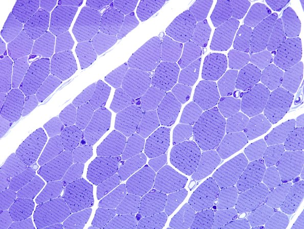 16A2-Mitochondriopathy-mild-Case-16-Plastic-1.jpg
