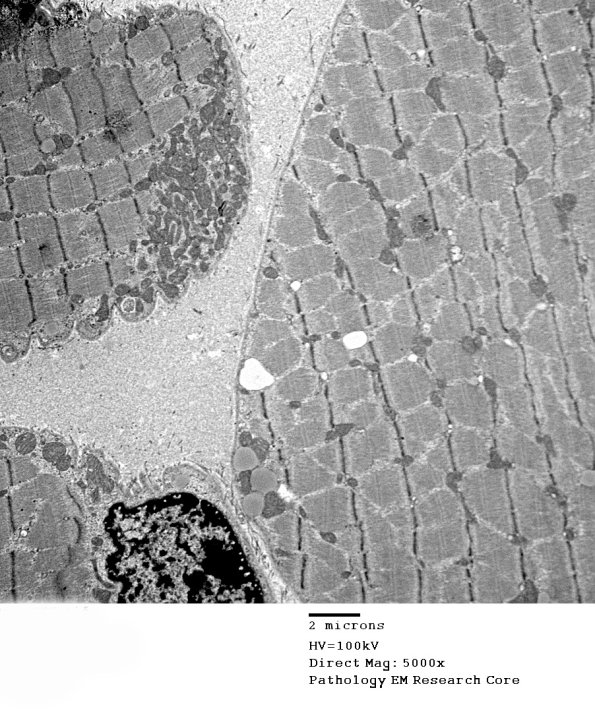 16B1A Mitochondriopathy, mild (Case 16) EM 007 - Copy