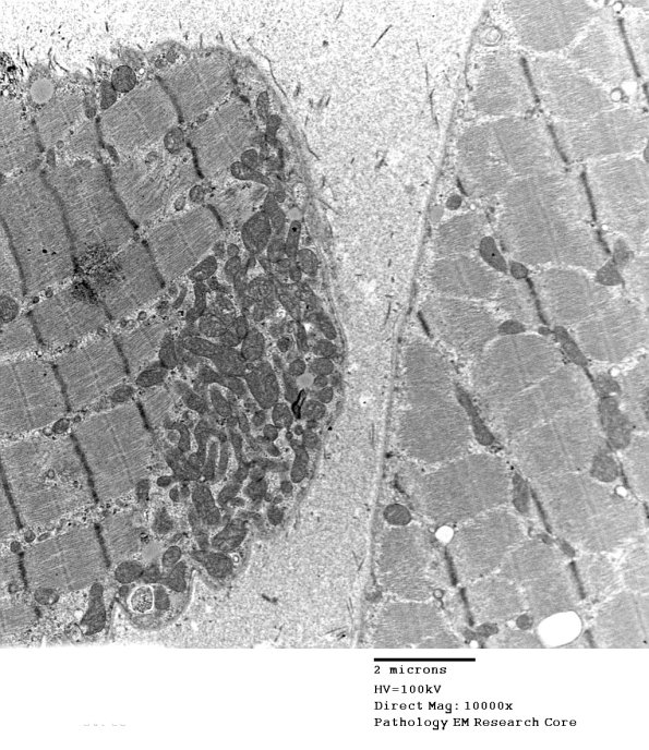 16B1B  Mitochondriopathy, mild (Case 16) EM 008 - Copy
