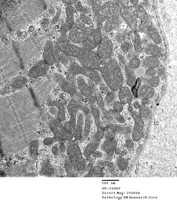 16B1C Mitochondriopathy, mild (Case 16) EM 009 - Copy