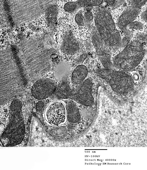 16B1D Mitochondriopathy, mild (Case 16) EM 010 - Copy