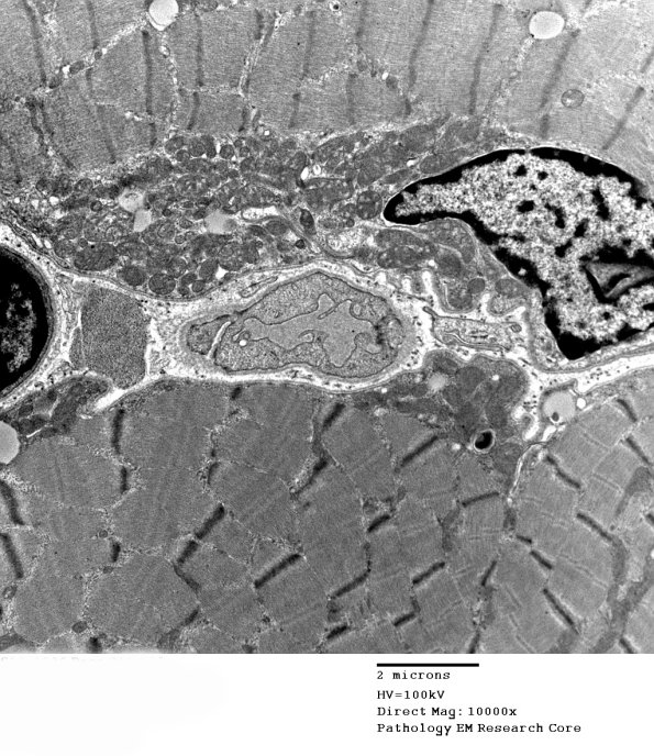 16B1E Mitochondriopathy, mild (Case 16) EM 015 - Copy