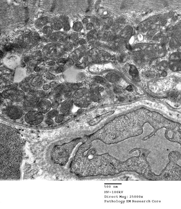 16B1F Mitochondriopathy, mild (Case 16) EM 016 - Copy