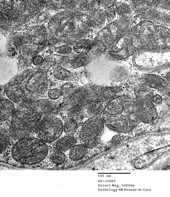 16B1G Mitochondriopathy, mild (Case 16) EM 017 - Copy