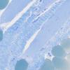18A1 (Case 18) Paraspinal 40X 2