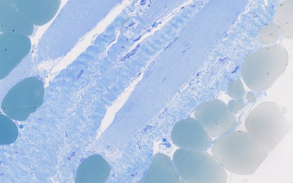18A1 (Case 18) Paraspinal 40X 2