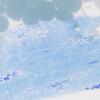 18A2 (Case 18) Paraspinal 100X 2