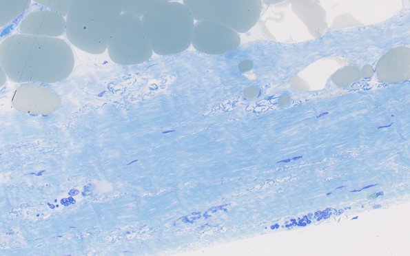 18A2 (Case 18) Paraspinal 100X 2