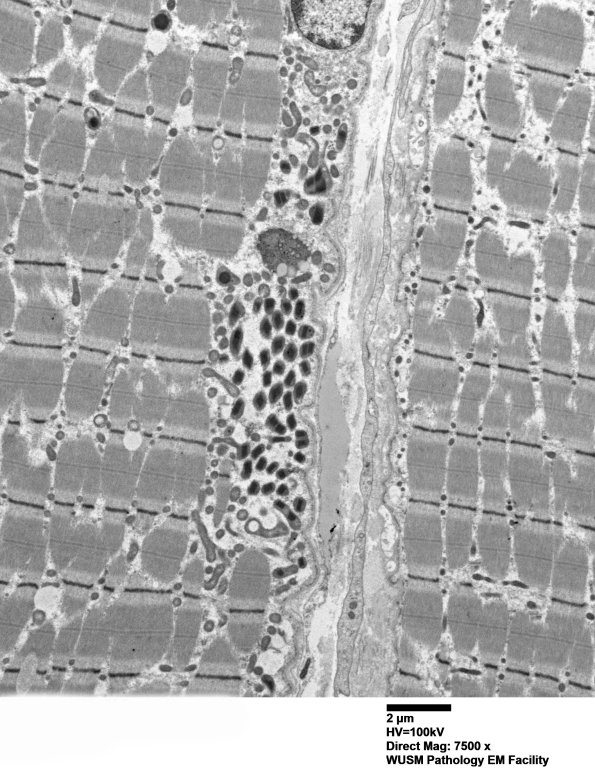 18B1A (Case 18) all 18B paraspinal muscle_006 - Copy