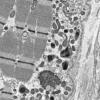 18B1B (Case 18) Paraspinal Muscle_008 - Copy