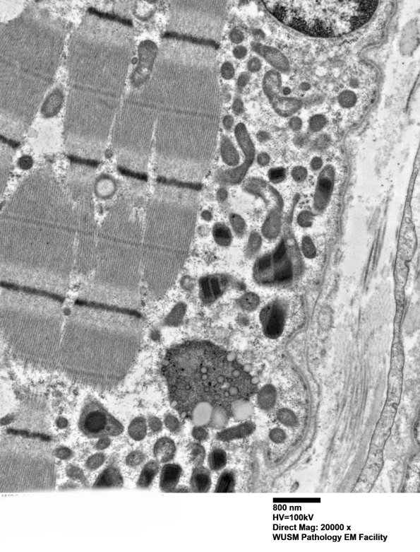 18B1B (Case 18) Paraspinal Muscle_008 - Copy