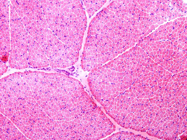 1A1 COD (Case 1, Mito myopathy) H&E 1