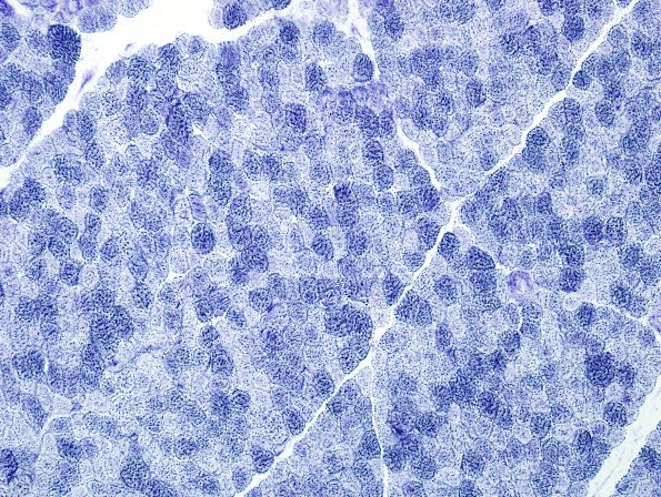 1B2 COD (Case 1, Mito myopathy) NADH-TR 1