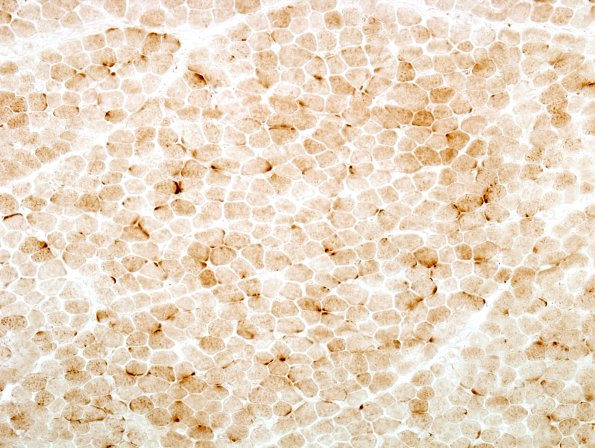 1C2 Cod (Case 1, Mito myopathy) Cyto Oxid 4