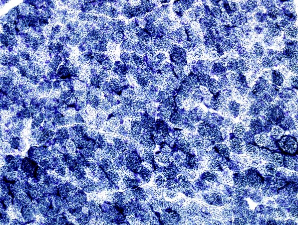1D2 CO deficiency Case 1, (Mito myopathy) SDH 3