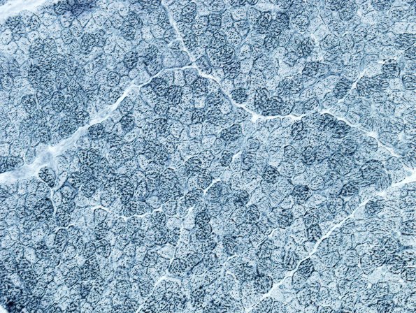 1E2 COD (Case 1, Mito myopathy) Sudan 2