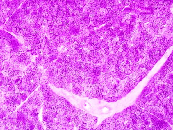 1F1 COD (Case 1, Mito myopathy) PAS 2