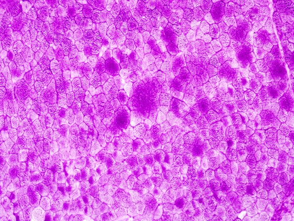 1F2 COD (Case 1, Mito myopathy) PAS 1