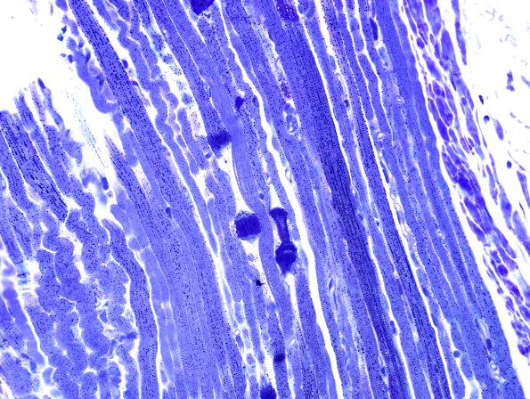 1G1 COD Case 1, Mito myopathy) Plastic 6