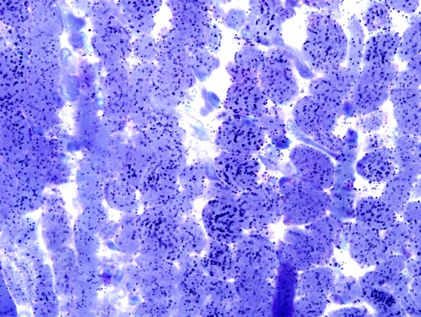 1G2 COD (Case 1, Mito myopathy) Plastic 2
