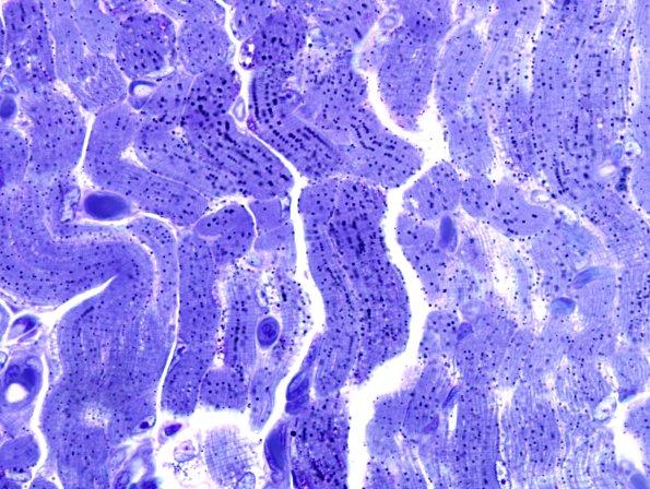1G3 COD  (Case 1, Mito myopathy) Plastic 1